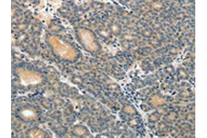 The image on the left is immunohistochemistry of paraffin-embedded Human thyroid cancer tissue using ABIN7189588(ABCC12 Antibody) at dilution 1/10, on the right is treated with synthetic peptide. (ABCC12 anticorps)