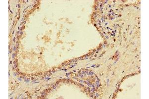 Immunohistochemistry of paraffin-embedded human prostate cancer using ABIN7162746 at dilution of 1:100 (PTCD2 anticorps  (AA 153-388))