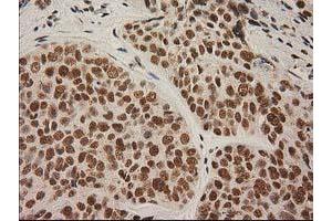 Immunohistochemical staining of paraffin-embedded Adenocarcinoma of Human breast tissue using anti-LOX mouse monoclonal antibody. (LOX anticorps  (AA 22-168))