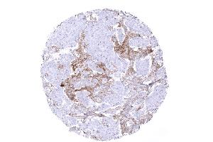 Breast Breast cancer NST with PD L1 negative tumor cells but intense PD L1 staining in tumor associated inflammatory cells (Recombinant PD-L1 anticorps)
