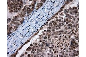 Immunohistochemical staining of paraffin-embedded Adenocarcinoma of breast tissue using anti-SRR mouse monoclonal antibody. (SRR anticorps)