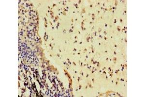 Immunohistochemistry of paraffin-embedded human lung cancer using ABIN7166936 at dilution of 1:100 (R-Spondin 3 anticorps  (AA 22-272))