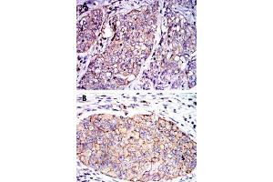 Immunohistochemical analysis of paraffin-embedded human lung cancer (A) and human kidney cancer (B) tissue using SERPINE1 monoclonal antobody, clone 1D5  with DAB staining. (PAI1 anticorps)