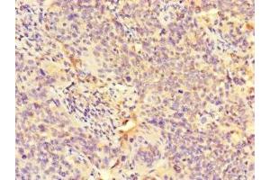 Immunohistochemistry of paraffin-embedded human cervical cancer using ABIN7163856 at dilution of 1:100 (GALNT11 anticorps  (AA 420-606))