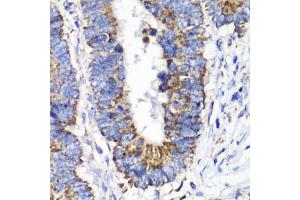 Immunohistochemistry of paraffin-embedded human colon carcinoma using RALB antibody (ABIN1682468, ABIN5664619, ABIN5664621 and ABIN6220484) at dilution of 1:100 (40x lens). (RALB anticorps  (AA 1-206))