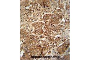 APCS antibody (C-term) immunohistochemistry analysis in formalin fixed and paraffin embedded human hepatocarcinoma followed by peroxidase conjugation of the secondary antibody and DAB staining. (APCS anticorps  (C-Term))