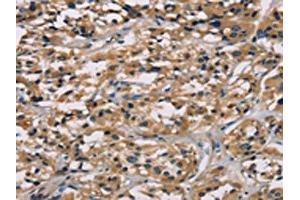 The image on the left is immunohistochemistry of paraffin-embedded Human thyroid cancer tissue using ABIN7128926(CGA Antibody) at dilution 1/65, on the right is treated with fusion protein. (CGA anticorps)