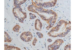 ABIN6269228 at 1/200 staining human breast cancer tissue sections by IHC-P.
