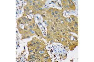 Immunohistochemistry of paraffin-embedded human lung cancer using RPB3/POLR2C Rabbit mAb (ABIN7269458) at dilution of 1:100 (40x lens). (POLR2C anticorps)