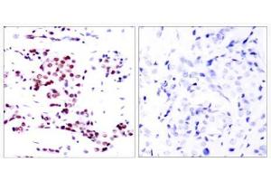 Immunohistochemical analysis of paraffin- embedded human breast carcinoma tissue using STAT5A (Ab-780) antibody (E021049). (STAT5A anticorps)