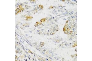 Immunohistochemistry of paraffin-embedded human uterine cancer using MLKL antibody (ABIN6134395, ABIN6143882, ABIN6143886 and ABIN6217454) at dilution of 1:100 (40x lens). (MLKL anticorps  (C-Term))
