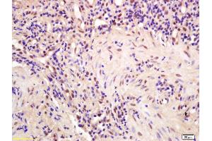 Formalin-fixed and paraffin embedded human gastric carcinoma labeled with Anti-CPSF4/CPSF30 Polyclonal Antibody, Unconjugated (ABIN1386751) at 1:200 followed by conjugation to the secondary antibody and DAB staining (CPSF4 anticorps  (AA 81-180))