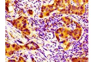 IHC image of ABIN7161386 diluted at 1:100 and staining in paraffin-embedded human pancreatic cancer performed on a Leica BondTM system. (NPAS2 anticorps  (AA 644-763))