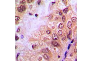 Immunohistochemical analysis of ABL1 (pY204) staining in human breast cancer formalin fixed paraffin embedded tissue section.
