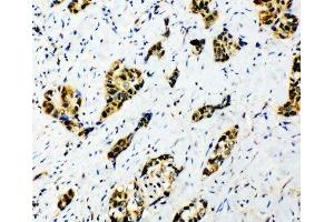 IHC-P: Splicing factor 1 antibody testing of human lung cancer tissue