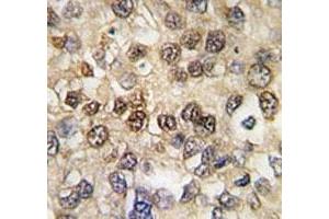 IHC analysis of FFPE human hepatocarcinoma tissue stained with RUNX2 antibody