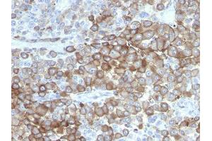 Image no. 1 for anti-Melanoma Marker antibody (ABIN6157214) (Melanoma Marker anticorps)