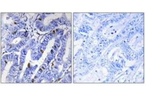 Immunohistochemical staining of human colon cancer (left). (PRKAR2B anticorps  (pSer113))