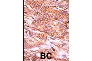 Formalin-fixed and paraffin-embedded human cancer tissue reacted with the primary antibody, which was peroxidase-conjugated to the secondary antibody, followed by AEC staining.
