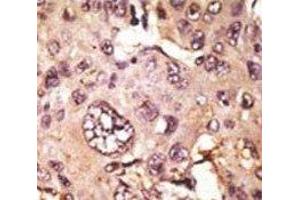 IHC analysis of FFPE human hepatocarcinoma tissue stained with the TAU antibody (tau anticorps  (AA 677-707))