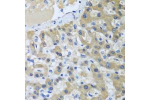 Immunohistochemistry of paraffin-embedded human liver cancer using XPC antibody (ABIN5974562) at dilution of 1/100 (40x lens). (XPC anticorps)