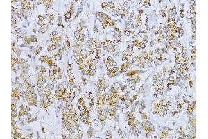 Immunohistochemistry of paraffin-embedded Human colon carcinoma using Aconitase 2  antibody (ABIN1678537, ABIN3017991, ABIN3017992 and ABIN6220329) at dilution of 1:100 (40x lens). (ACO2 anticorps  (AA 501-780))