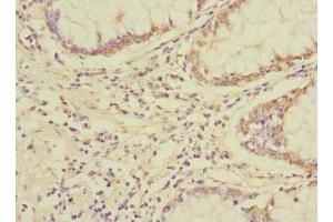 Immunohistochemistry of paraffin-embedded human colon cancer using ABIN7174422 at dilution of 1:100 (UBAP1 anticorps  (AA 1-300))