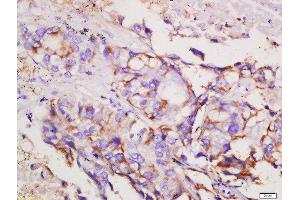 Formalin-fixed and paraffin embedded human lung carcinoma labeled with Rabbit Anti-CCR6/CD196 Polyclonal Antibody, Unconjugated  at 1:200 followed by conjugation to the secondary antibody and DAB staining (CCR6 anticorps  (AA 201-300))