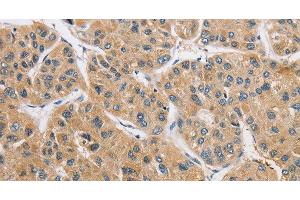 Immunohistochemistry of paraffin-embedded Human liver cancer using ARHGAP15 Polyclonal Antibody at dilution of 1:50 (ARHGAP15 anticorps)