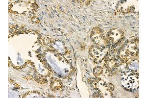 FAS Mouse Monoclonal Antibody at 1/100 staining human ovarian cancer by IHC-P. (FAS anticorps  (C-Term))