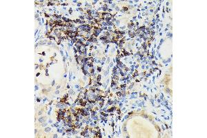 Immunohistochemistry of paraffin-embedded human thyroid cancer using PIK3CG Rabbit pAb (ABIN6130600, ABIN6145638, ABIN6145639 and ABIN6222396) at dilution of 1:100 (40x lens). (PIK3 gamma anticorps  (AA 1-200))