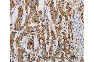 Immunohistochemistry of Human breast cancer using IFITM3 Polyclonal Antibody at dilution of 1:20