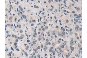 Detection of MMP19 in Human Prostate cancer Tissue using Polyclonal Antibody to Matrix Metalloproteinase 19 (MMP19)