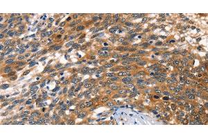 Immunohistochemistry of paraffin-embedded Human cervical cancer tissue using AGO1 Polyclonal Antibody at dilution 1:40 (AGO1 anticorps)