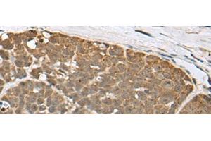 Immunohistochemistry of paraffin-embedded Human thyroid cancer tissue using SPRTN Polyclonal Antibody at dilution of 1:65(x200) (Spartan anticorps)