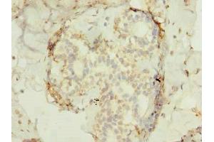 Immunohistochemistry of paraffin-embedded human breast cancer using ABIN7165522 at dilution of 1:100 (FAM53B anticorps  (AA 1-305))