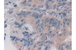 Detection of LGMN in Human Colorectal cancer Tissue using Polyclonal Antibody to Legumain (LGMN)