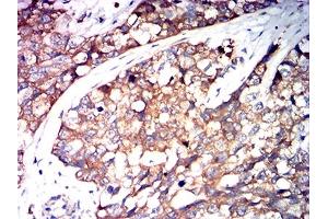 Immunohistochemical analysis of paraffin-embedded bladder cancer tissues using SERPINA1 mouse mAb with DAB staining.