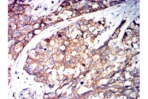 Immunohistochemical analysis of paraffin-embedded bladder cancer tissues using SERPINA1 mouse mAb with DAB staining. (SERPINA1 anticorps  (AA 269-419))