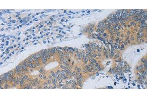 Immunohistochemistry of paraffin-embedded Human colon cancer tissue using MT2A Polyclonal Antibody at dilution 1:40 (MT2A anticorps)
