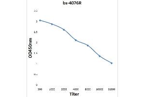 Formalin-fixed and paraffin embedded human gastric carcinoma labeled with Anti-phospho-E2F1(Ser364) Polyclonal Antibody, Unconjugated (ABIN753478) at 1:200 followed by conjugation to the secondary antibody and DAB staining.