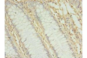 Immunohistochemistry of paraffin-embedded human colon cancer using ABIN7142391 at dilution of 1:100 (MRPL3 anticorps  (AA 201-348))