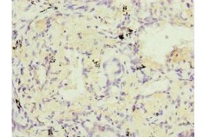 Immunohistochemistry of paraffin-embedded human lung cancer using ABIN7164323 at dilution of 1:100