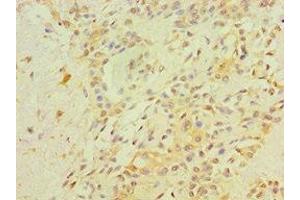 Immunohistochemistry of paraffin-embedded human breast cancer using ABIN7167784 at dilution of 1:100