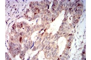 Immunohistochemical analysis of paraffin-embedded rectum cancer tissues using AURKA mouse mAb with DAB staining.