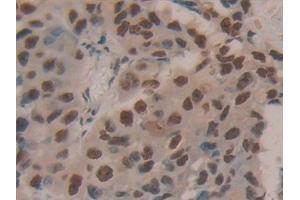 Detection of HDGF in Human Breast cancer Tissue using Polyclonal Antibody to Hepatoma Derived Growth Factor (HDGF) (HDGF anticorps  (AA 10-240))