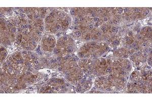 ABIN6273982 at 1/100 staining Human liver cancer tissue by IHC-P. (OR2T27 anticorps  (Internal Region))