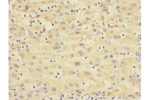 Immunohistochemistry of paraffin-embedded human liver cancer using ABIN7167664 at dilution of 1:100 (Relaxin 3 Receptor 1 anticorps  (AA 1-80))