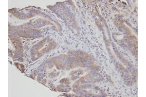 IHC-P Image Immunohistochemical analysis of paraffin-embedded human T(gastric cancer) , using NSMAF, antibody at 1:100 dilution. (NSMAF anticorps)