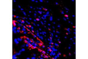 Immunofluorescence of paraffin embedded human breast cancer using ANXA3 (ABIN7073065) at dilution of 1: 300 (400x lens)